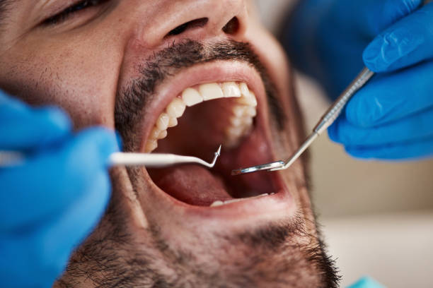 Best Chipped Tooth Repair Near Me  in Reisterstown, MD